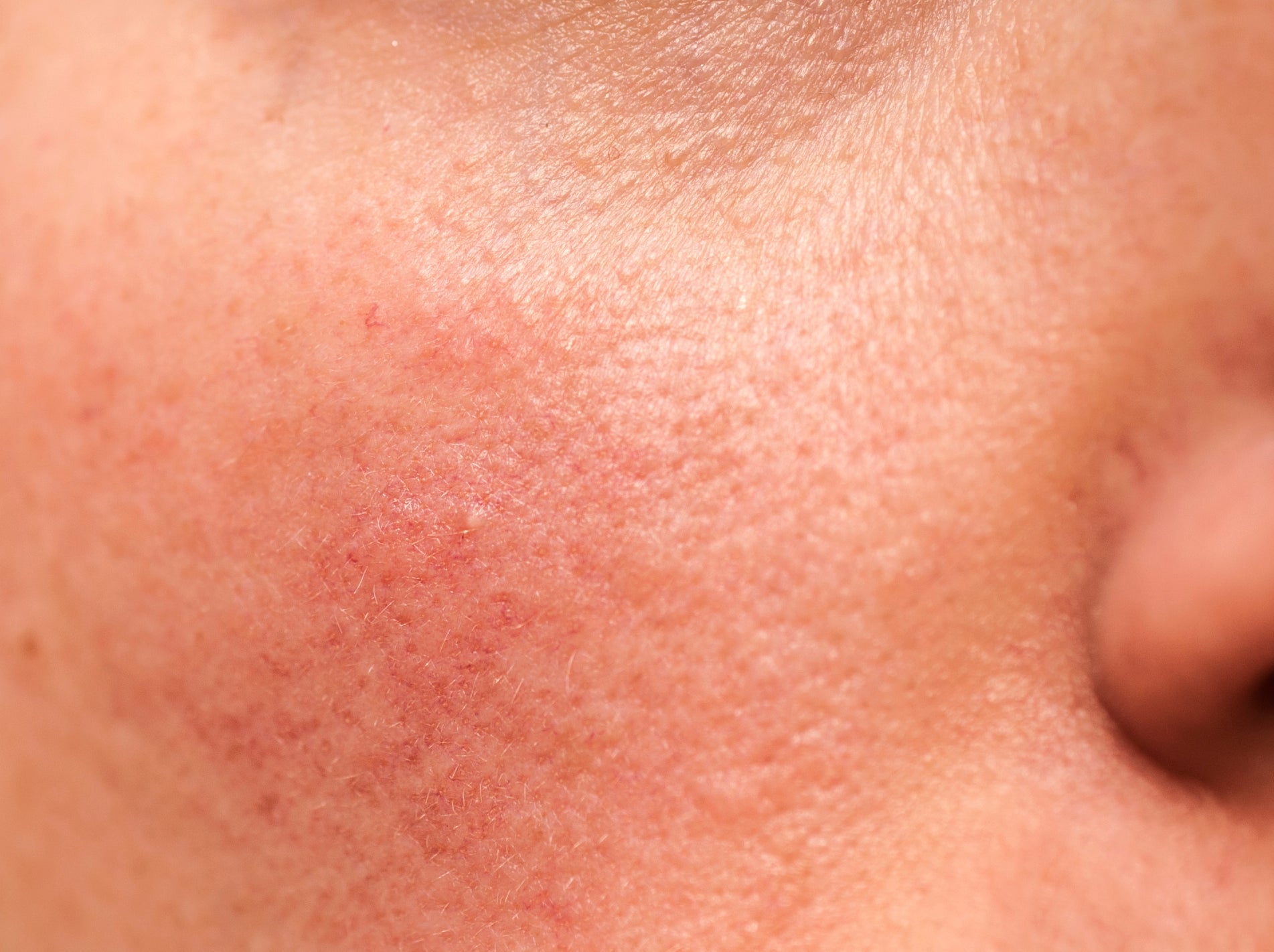 Redness / Rosacea