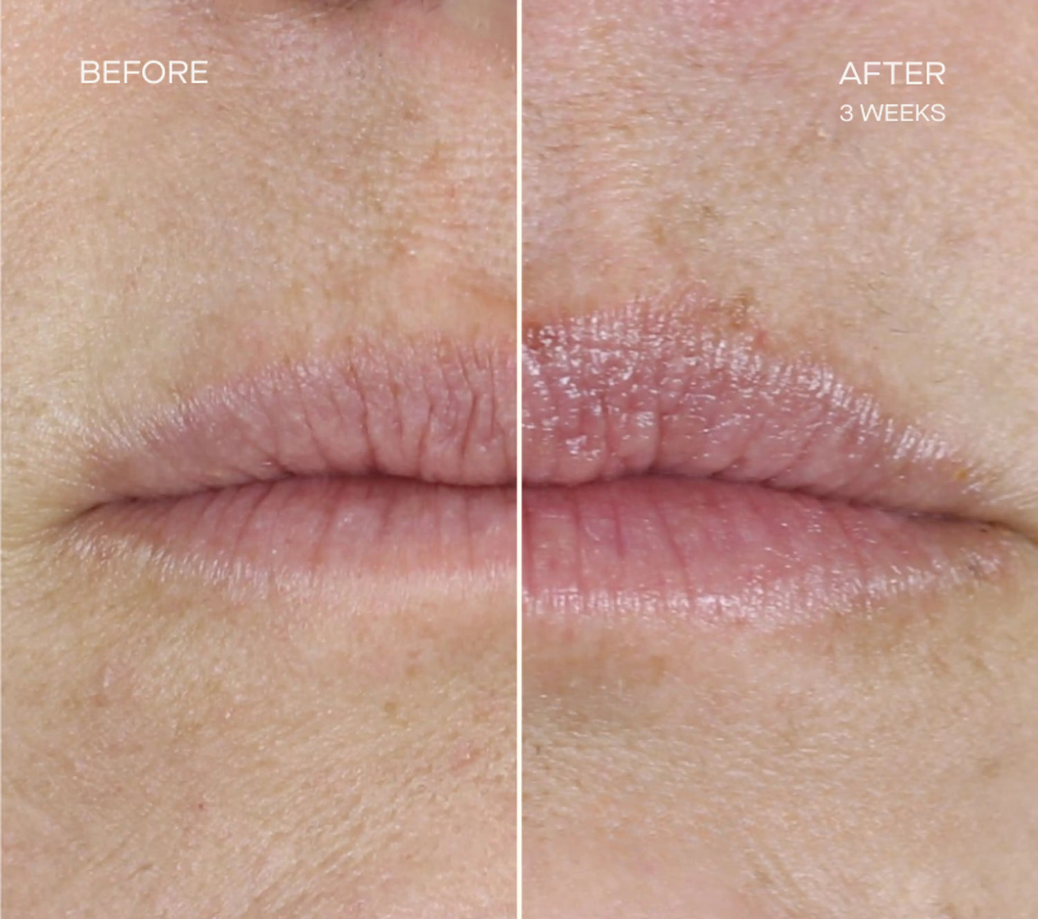 Ourself Lip Filler Set