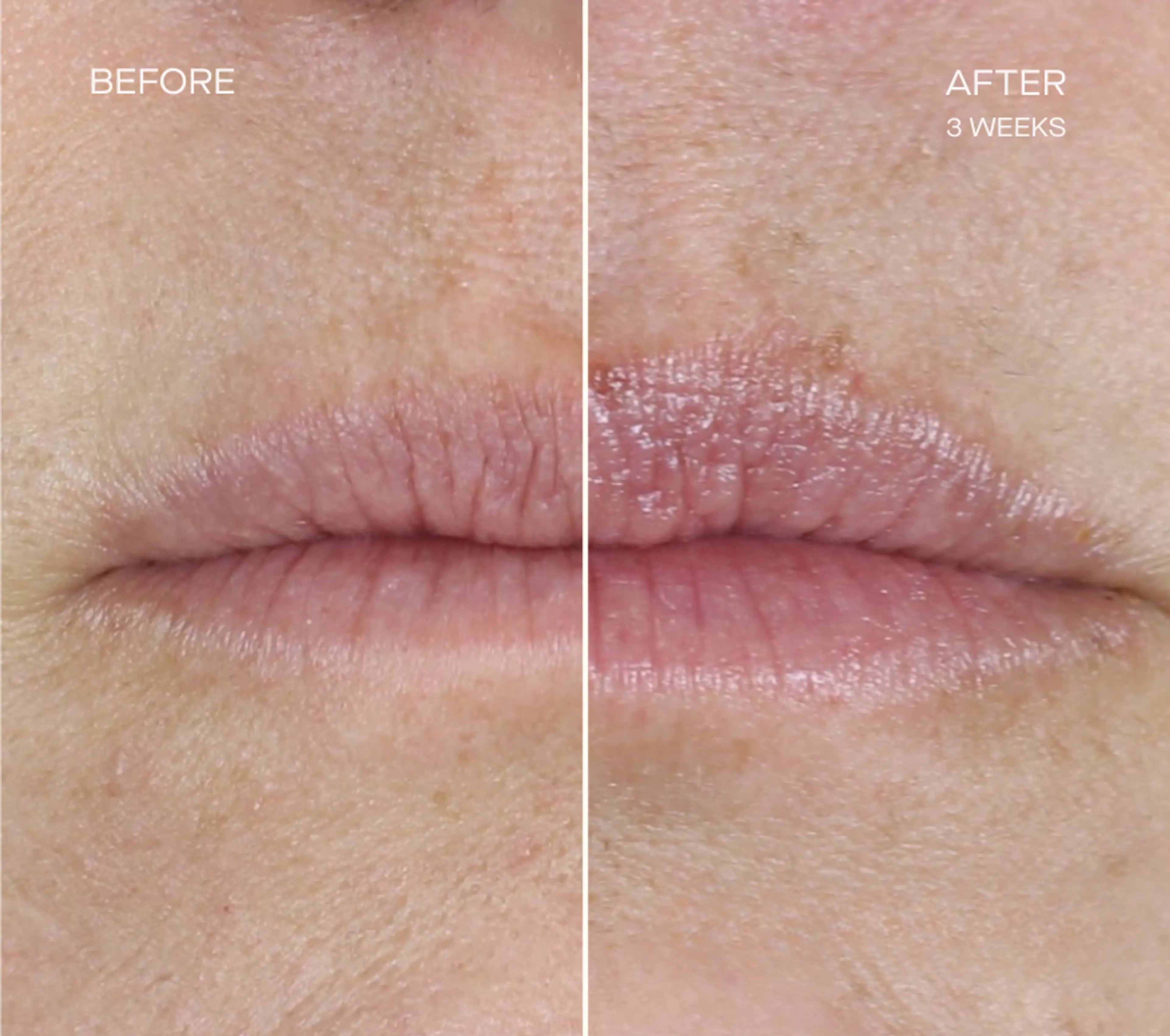 Ourself Lip Filler Set